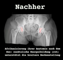 Hüfte nachher.jpg